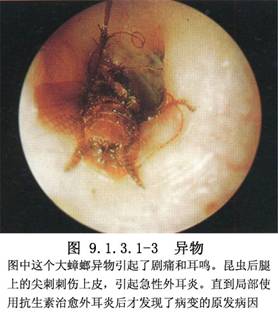 遇到外耳道异物怎么办