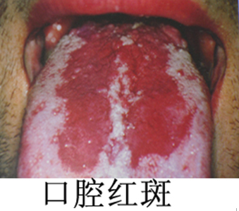 麻疹口腔黏膜柯氏斑图片